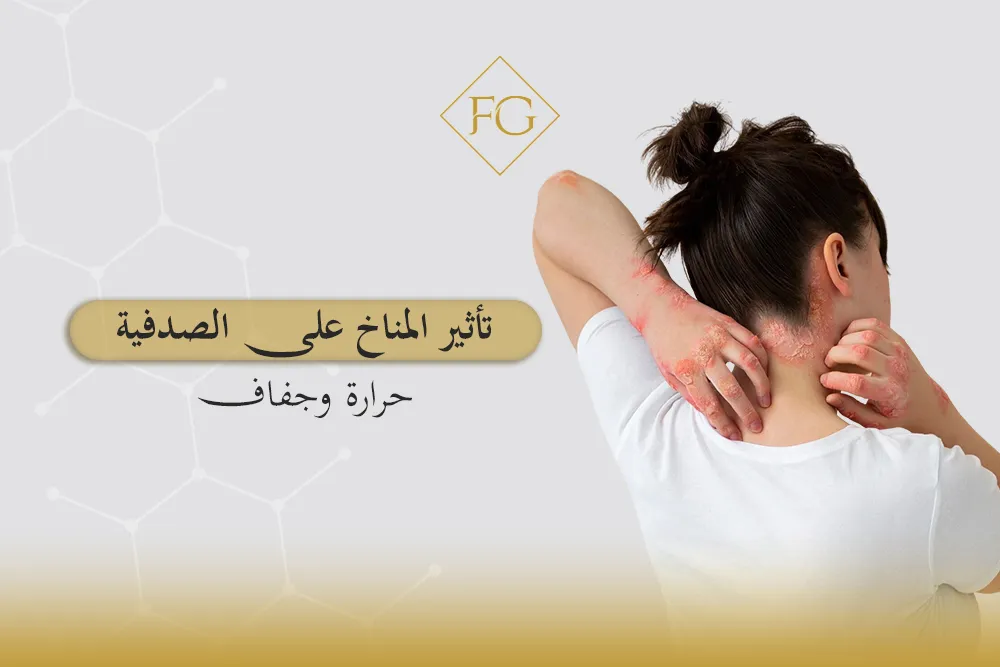 تأثير المناخ على الصدفية