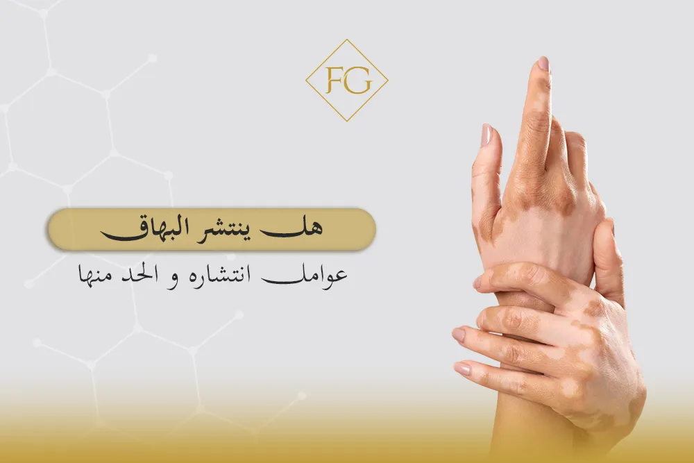هل ينتشر البهاق