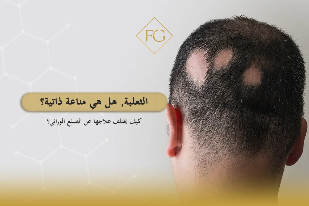 الفرق بين الثعلبة والصلع الوراثي
