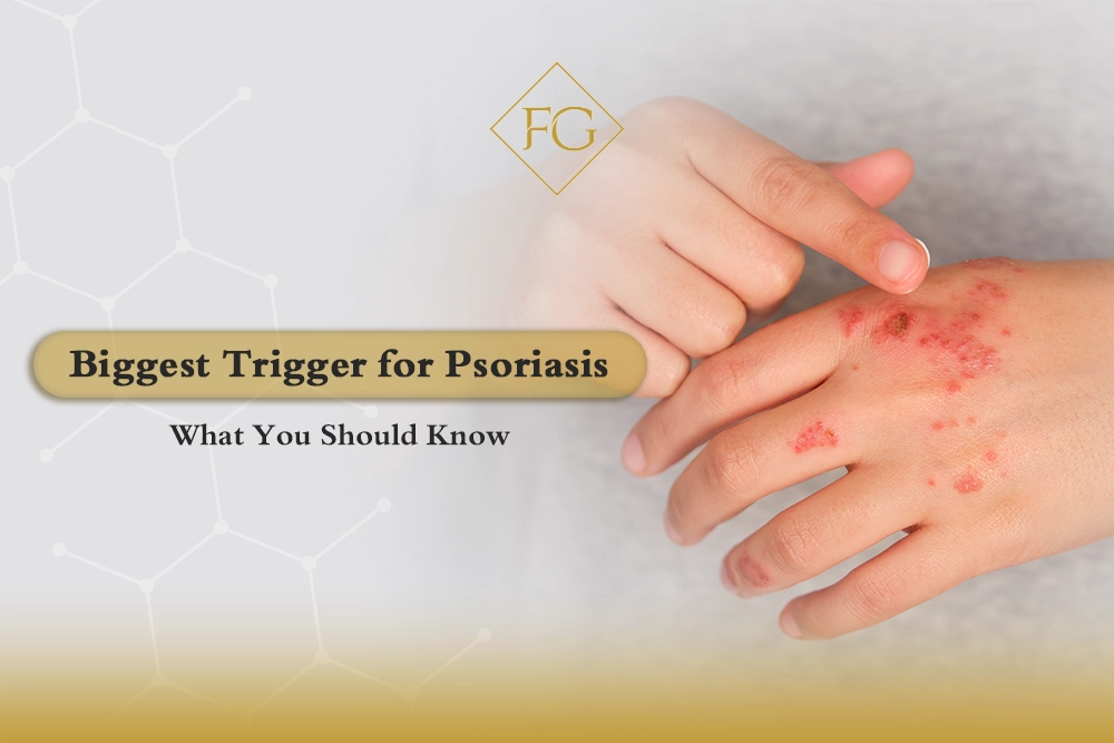 Psoriasis flare up treatment