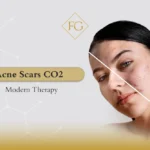 Acne Scars CO2