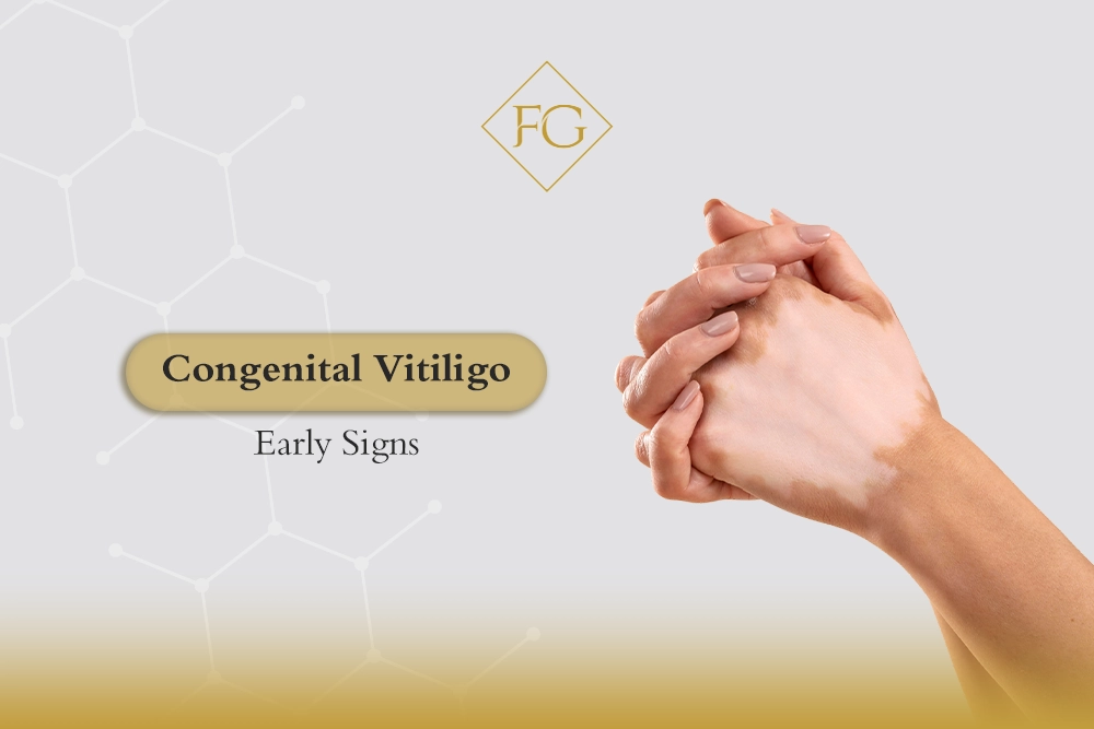 Congenital vitiligo