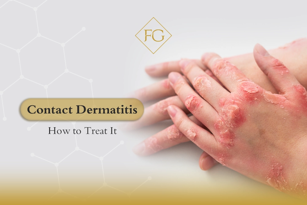 Contact dermatitis
