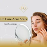 How to cure acne scars