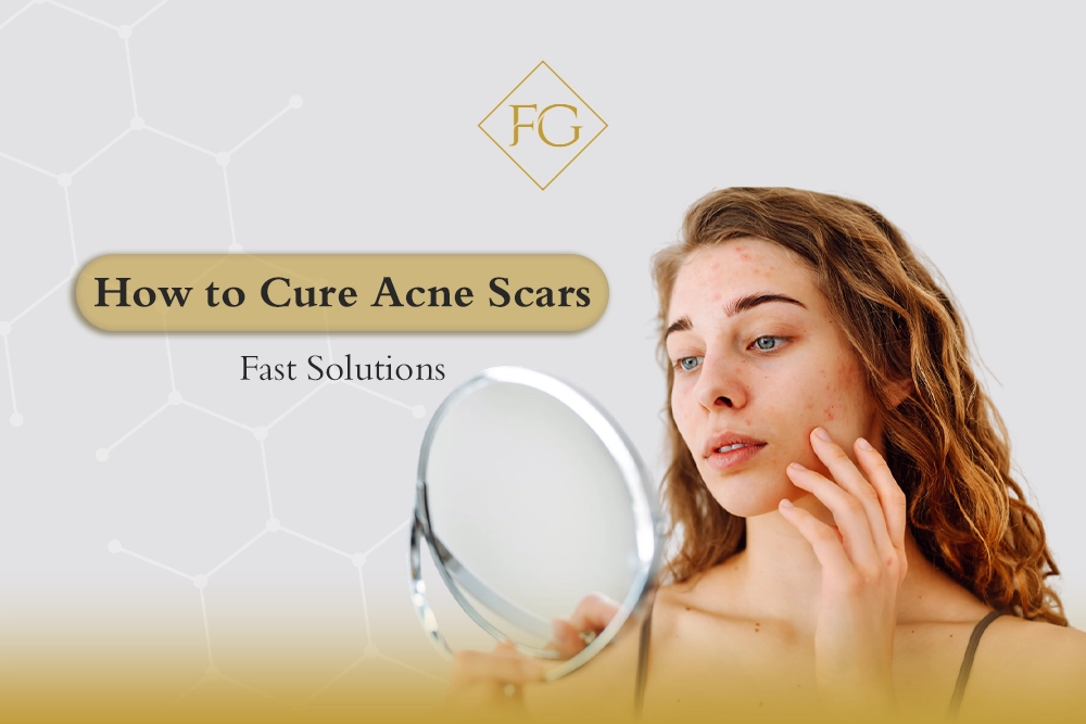 How to cure acne scars