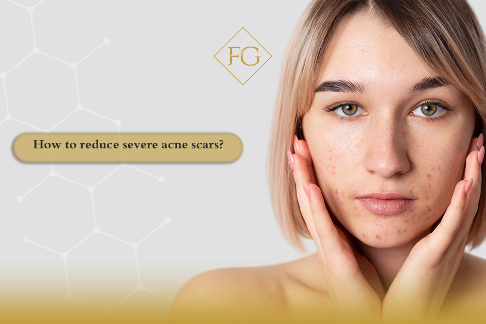 severe acne scars
