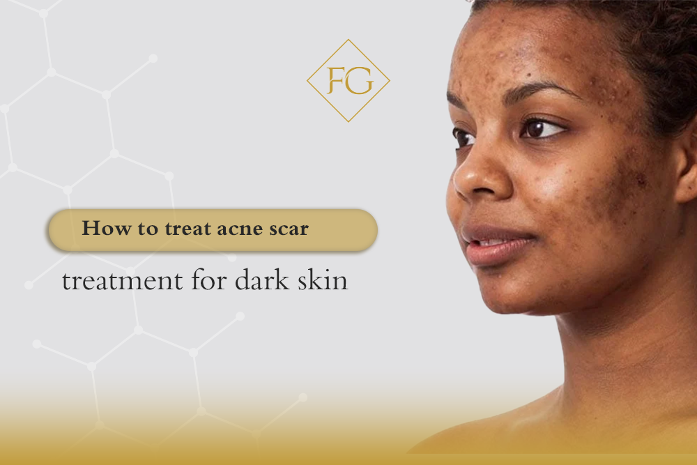 acne scar treatment for dark skin