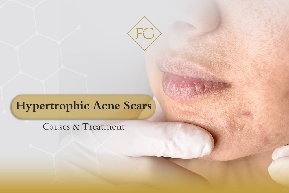 Hypertrophic acne scars