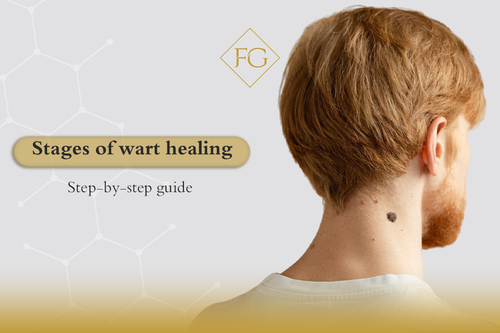 Stages of wart healing