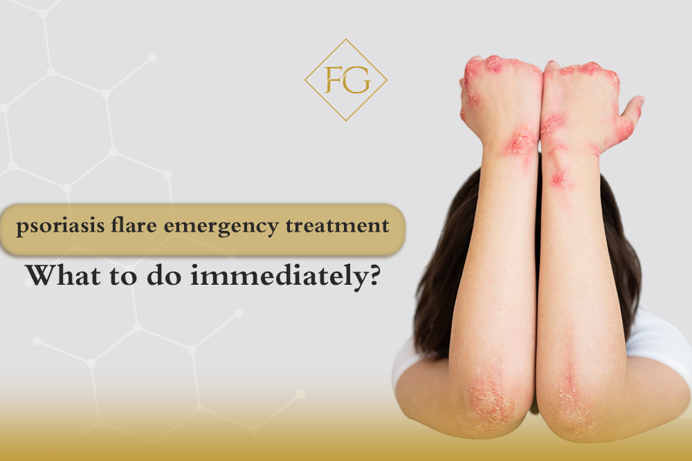 Psoriasis flare emergency treatment
