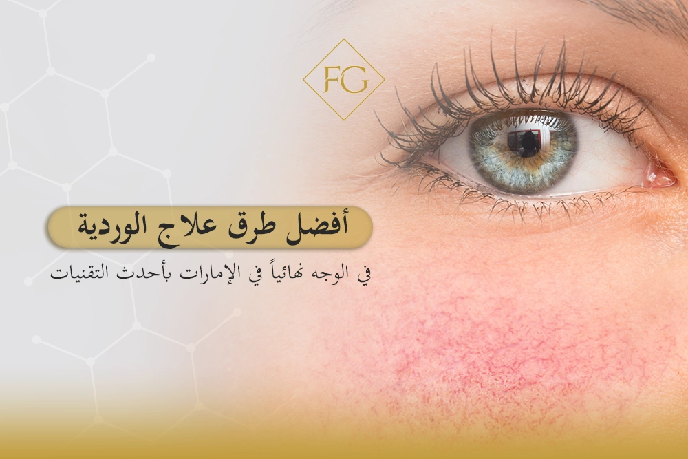 علاج الوردية في الوجه نهائياً