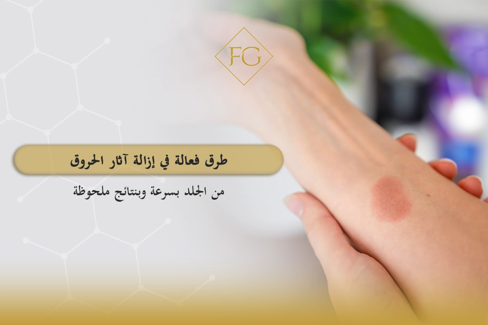 إزالة آثار الحروق من الجلد بسرعة