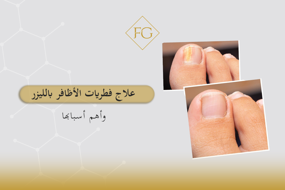 علاج فطريات الأظافر بالليزر