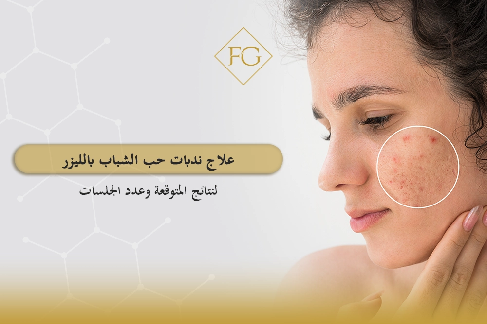 علاج ندبات حب الشباب بالليزر