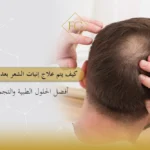 علاج إنبات الشعر بعد الثعلبة