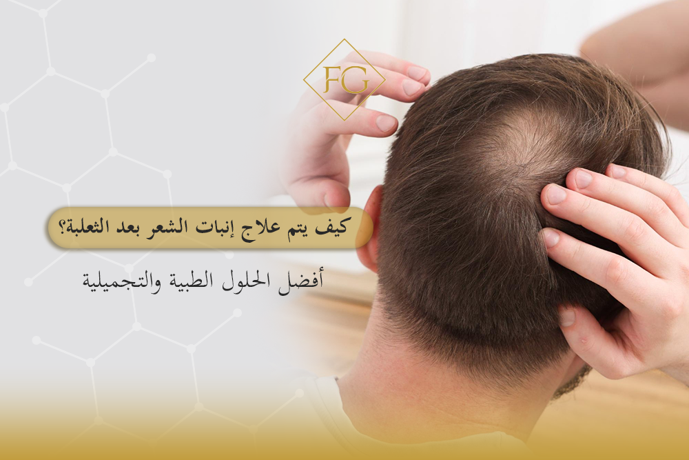 علاج إنبات الشعر بعد الثعلبة