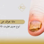 أنواع عدوى فطريات الأظافر