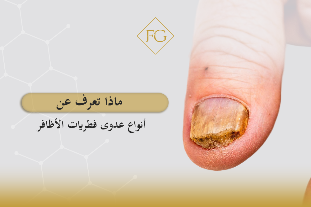 أنواع عدوى فطريات الأظافر