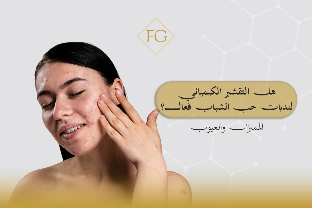 التقشير الكيميائي لندبات حب الشباب