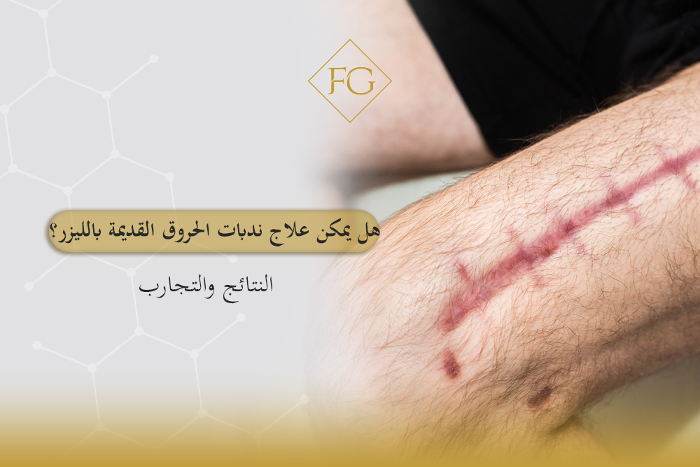 علاج ندبات الحروق القديمة بالليزر