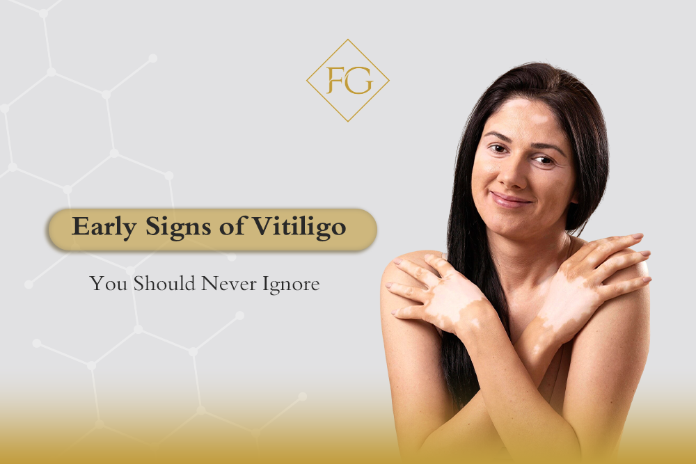 early signs of vitiligo