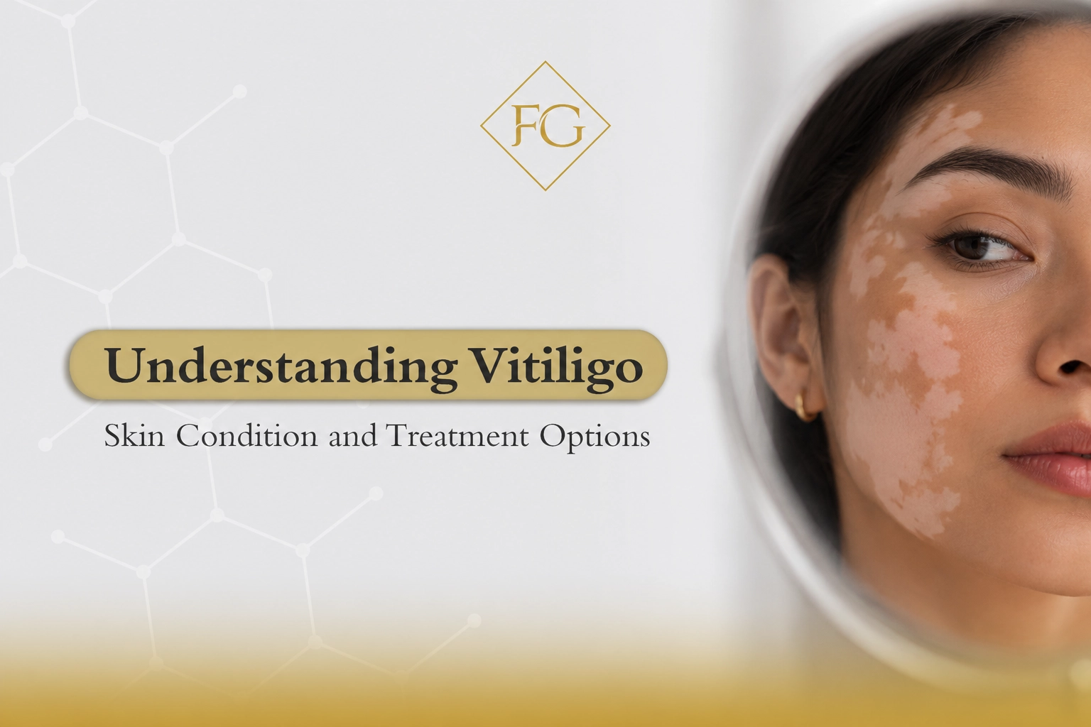 vitiligo skin condition