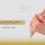 أخف انواع الصدفية