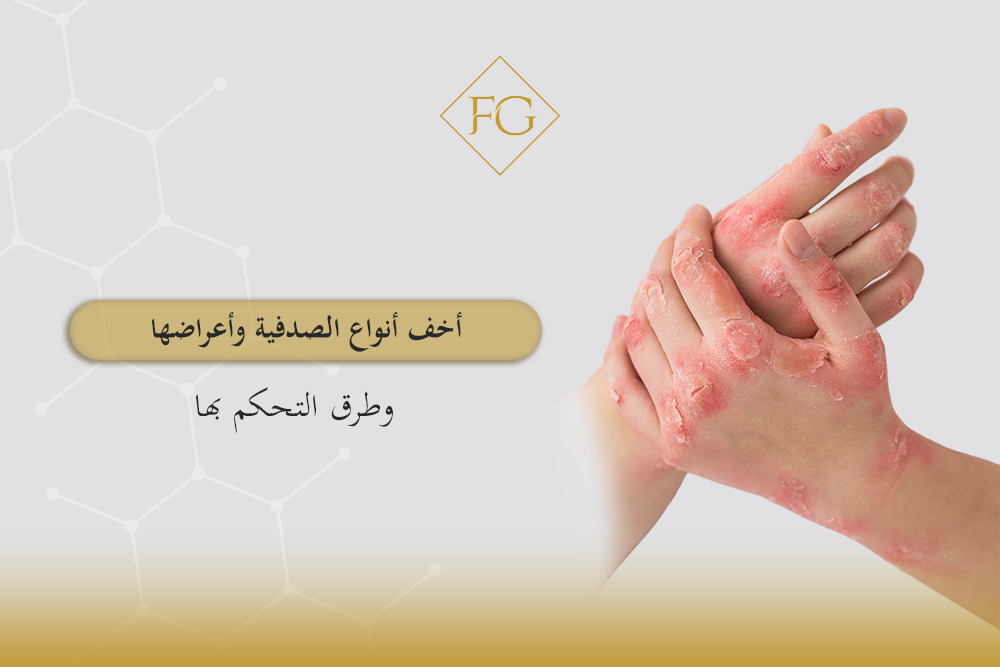 أخف انواع الصدفية