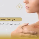علاج الحروق والندبات