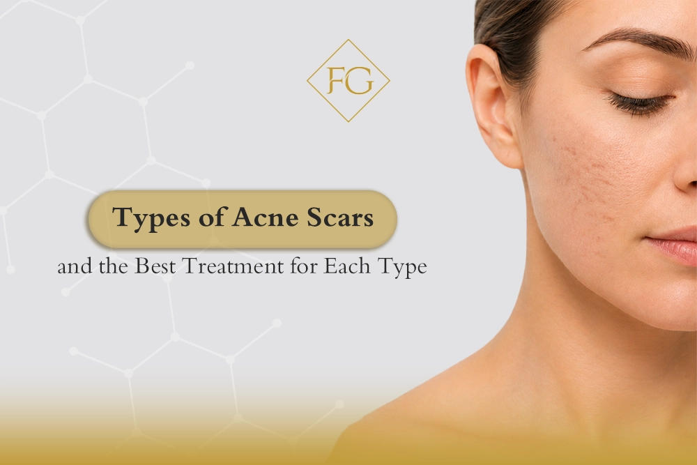 Types of Acne Scars and Treatment